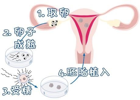 关于人工孕妈代怀助孕咨询怎么选